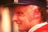 Lauda carried the scars from his 1976 crash for the rest of his life.